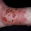 126. Contact Dermatitis in Adults Pictures