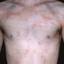 128. Contact Dermatitis in Adults Pictures