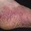 129. Contact Dermatitis in Adults Pictures