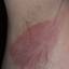 13. Contact Dermatitis in Adults Pictures