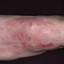 134. Contact Dermatitis in Adults Pictures