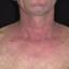 14. Contact Dermatitis in Adults Pictures