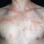 143. Contact Dermatitis in Adults Pictures
