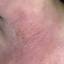 145. Contact Dermatitis in Adults Pictures