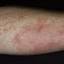 148. Contact Dermatitis in Adults Pictures