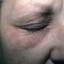 15. Contact Dermatitis in Adults Pictures