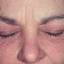 150. Contact Dermatitis in Adults Pictures