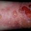 151. Contact Dermatitis in Adults Pictures