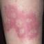 152. Contact Dermatitis in Adults Pictures