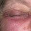 153. Contact Dermatitis in Adults Pictures
