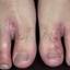 155. Contact Dermatitis in Adults Pictures