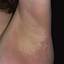 19. Contact Dermatitis in Adults Pictures