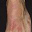 20. Contact Dermatitis in Adults Pictures