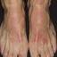 21. Contact Dermatitis in Adults Pictures