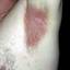 26. Contact Dermatitis in Adults Pictures