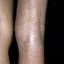 29. Contact Dermatitis in Adults Pictures