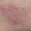30. Contact Dermatitis in Adults Pictures