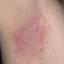 31. Contact Dermatitis in Adults Pictures