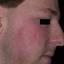 36. Contact Dermatitis in Adults Pictures