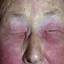 4. Contact Dermatitis in Adults Pictures