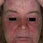 42. Contact Dermatitis in Adults Pictures