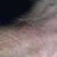 48. Contact Dermatitis in Adults Pictures