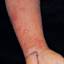 5. Contact Dermatitis in Adults Pictures