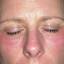 59. Contact Dermatitis in Adults Pictures