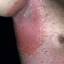 62. Contact Dermatitis in Adults Pictures