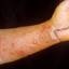 65. Contact Dermatitis in Adults Pictures