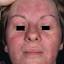 66. Contact Dermatitis in Adults Pictures