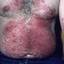 68. Contact Dermatitis in Adults Pictures