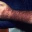 69. Contact Dermatitis in Adults Pictures