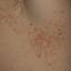 73. Contact Dermatitis in Adults Pictures