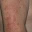 76. Contact Dermatitis in Adults Pictures