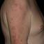 77. Contact Dermatitis in Adults Pictures