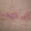 80. Contact Dermatitis in Adults Pictures