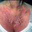 83. Contact Dermatitis in Adults Pictures