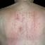 95. Contact Dermatitis in Adults Pictures