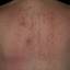 96. Contact Dermatitis in Adults Pictures
