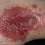 99. Contact Dermatitis in Adults Pictures
