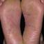 14. Shoe Contact Dermatitis Pictures