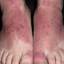 19. Shoe Contact Dermatitis Pictures