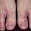 25. Shoe Contact Dermatitis Pictures