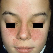 Allergic Contact Dermatitis Baby