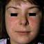 3. Allergic Contact Dermatitis Baby Pictures