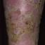 1. Venous Eczema on Legs Pictures