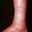 100. Venous Eczema on Legs Pictures