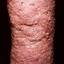 101. Venous Eczema on Legs Pictures