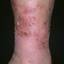 103. Venous Eczema on Legs Pictures